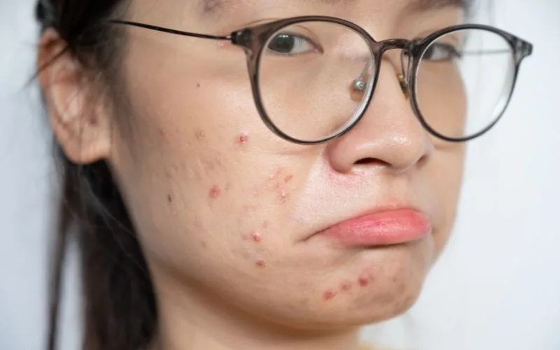 A Comprehensive Guide to Acne Free Clear Skin in Singapore