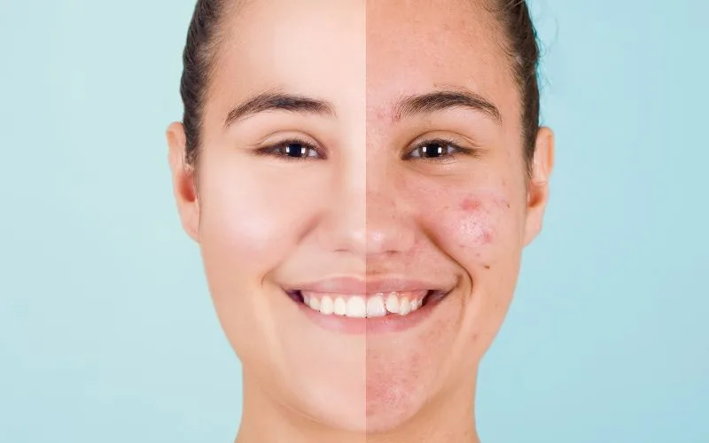 Acne Face Map Understand breakouts & how to solve them