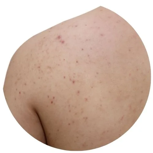 Active Acne, Scars, and Pigmentation back treatment