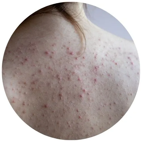 Active back Acne treatment