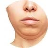 Area of Treatment for Ultherapy double chin