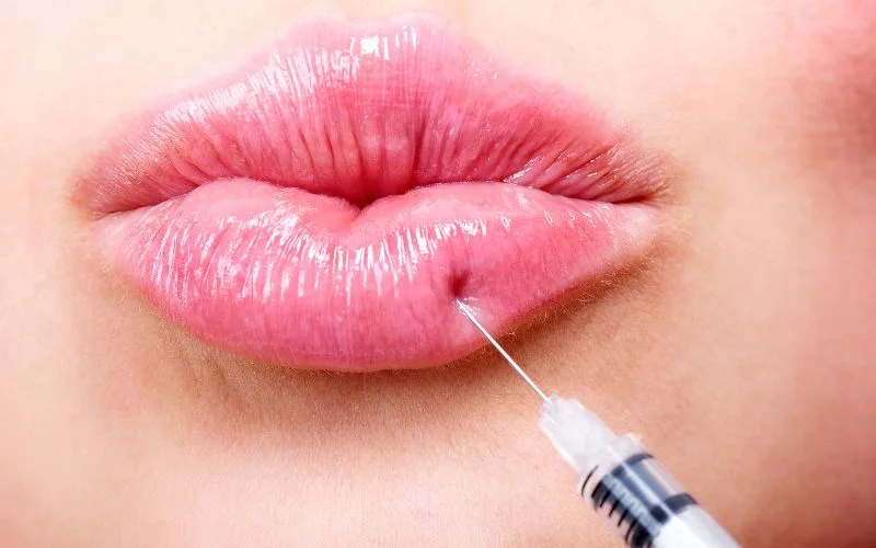 Benefits of lip augmentation with lip fillers