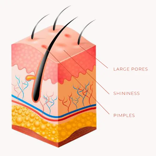 Causes of Acnes & Acne Scars treatments