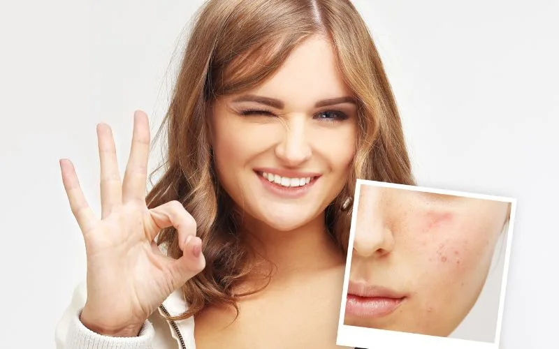 Choosing the Right Acne Scar Treatment