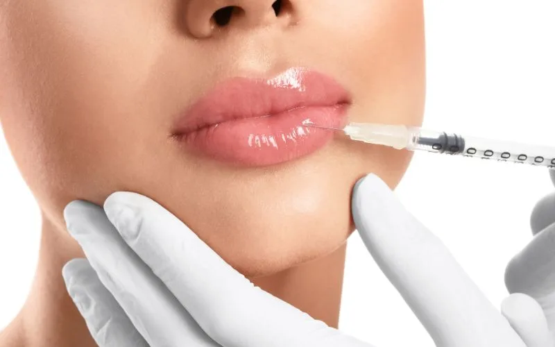 Cost of Lip Fillers