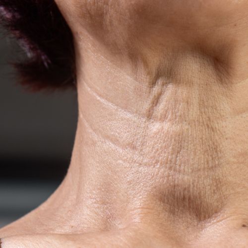 Décolletage Concern and treatment