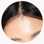 Ellanse collagen stimulator Forehead Treatment