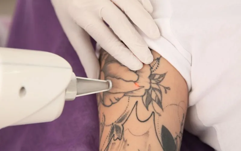 Facts you need to know before getting tattoo removal service