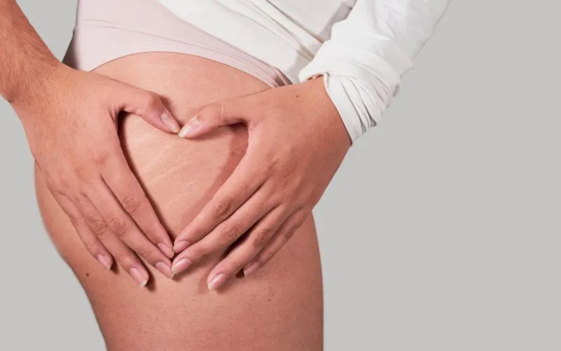 From Bumps to Beauty A New Mum’s Guide to Understanding and Treat Stretch Marks