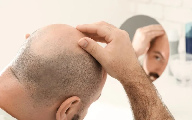 Hair Growth Myth 3 Everyone goes bald by 50