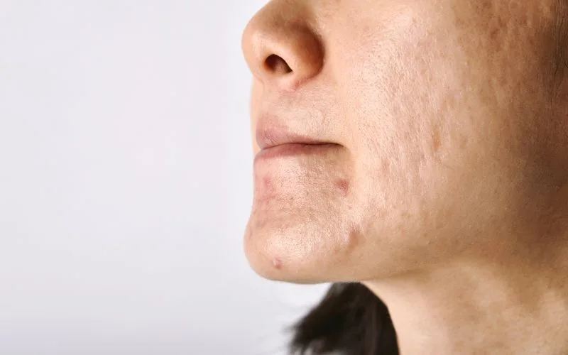 Lasers Pimple Scar Removal