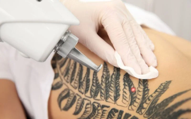 tattoo removal scar - Lasers tattoo removal doesn't burn your skin