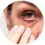 Loose or Sagging Skin Under the Eyes