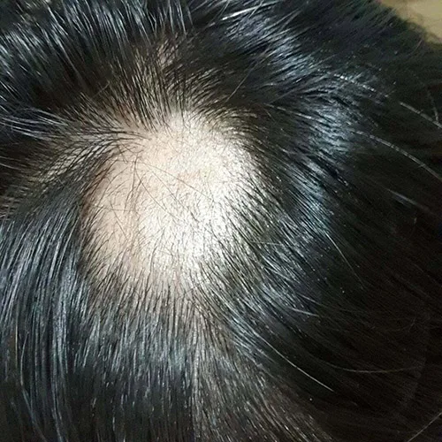 Loss-of-hair-from-destroyed-hair-follicles-causing-scarring-permanent-hair-loss