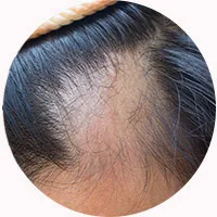 Male Pattern Hair Loss