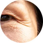 Morpheus8-treatment-Fine-lines-and-wrinkles