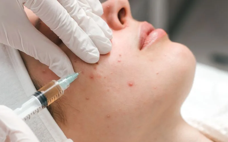 Non-Invasive Acne Scar Treatments