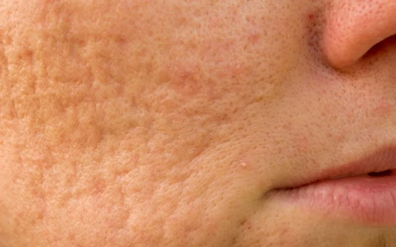 Picosure Laser Acne Scars Reduction
