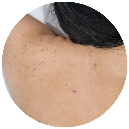 Pigmentation and Post-Inflammatory Marks back treatment