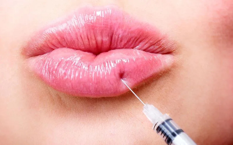 Quick Lip Filler Injection is a Quick Procedure 