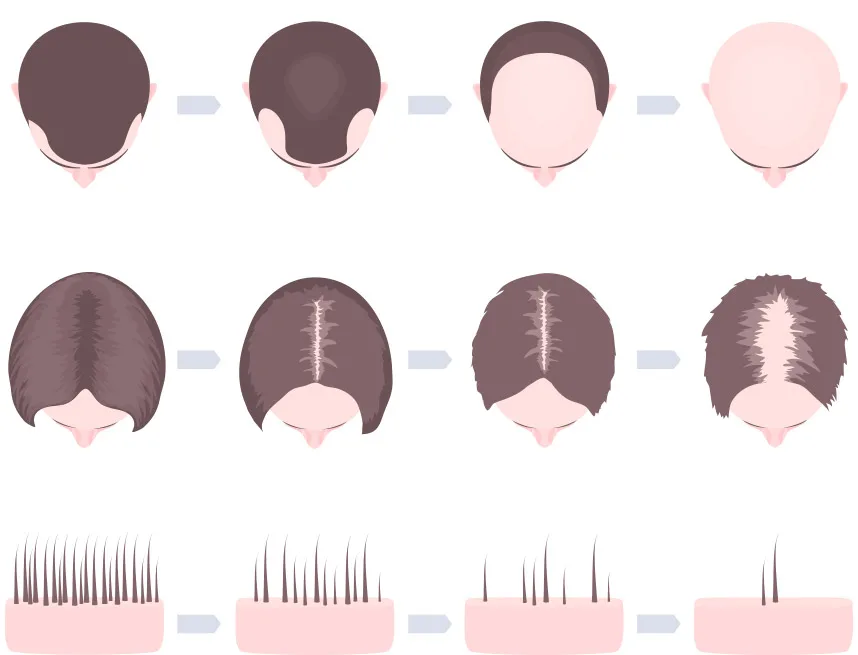 Regenera Activa Hair Loss pattern