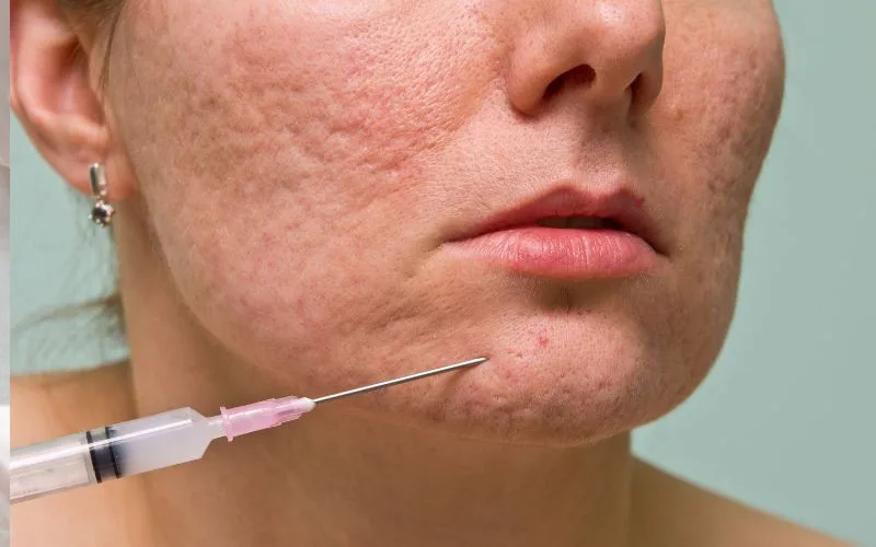 Rejuran Treatment for Acne Scars