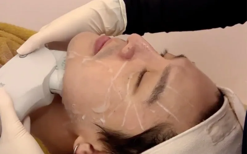 Saggy Face Skin Treatment with Ultherapy