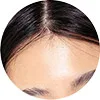 Sculptra treatment for forehead