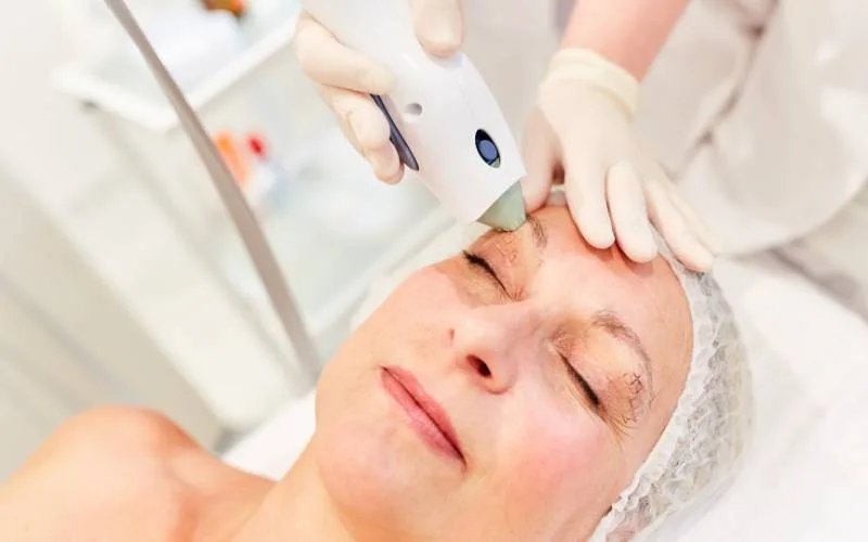Thermage FLX Eye Non-Surgical Procedure for Dark Eye Circle
