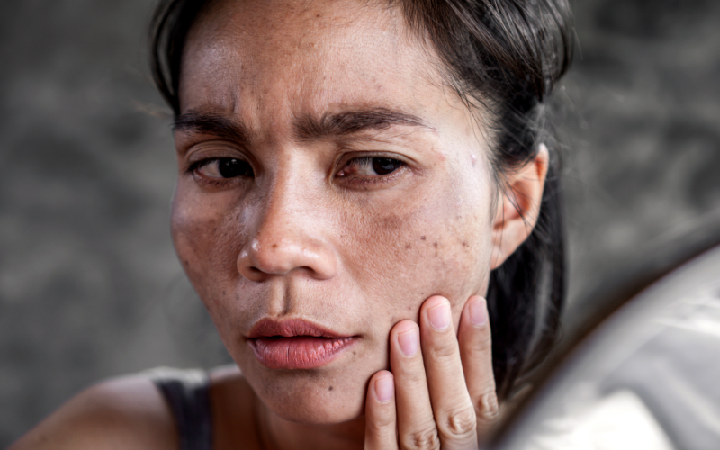 Post-Inflammatory Hyperpigmentation (PIH)