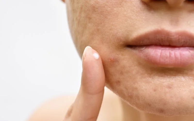 Treatments for acne at Kowayo Aesthetic Clinic