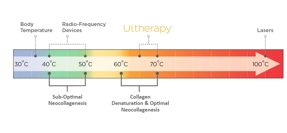 Ultherapy heats tissue to optimal temperature for stimulating new collagen growth