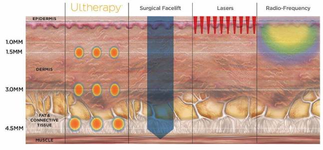 Ultherapy treatment treats at the precise depth and temperature