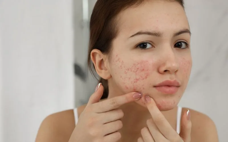 Understanding Acne Scars in Singapore