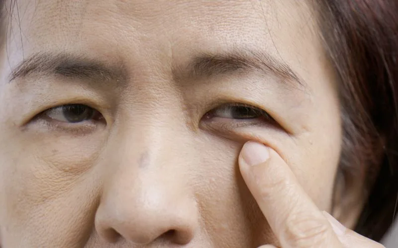 Understanding Eye Bags and Their Causes