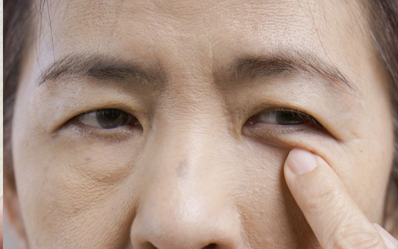Understanding Eye Bags and their Causes