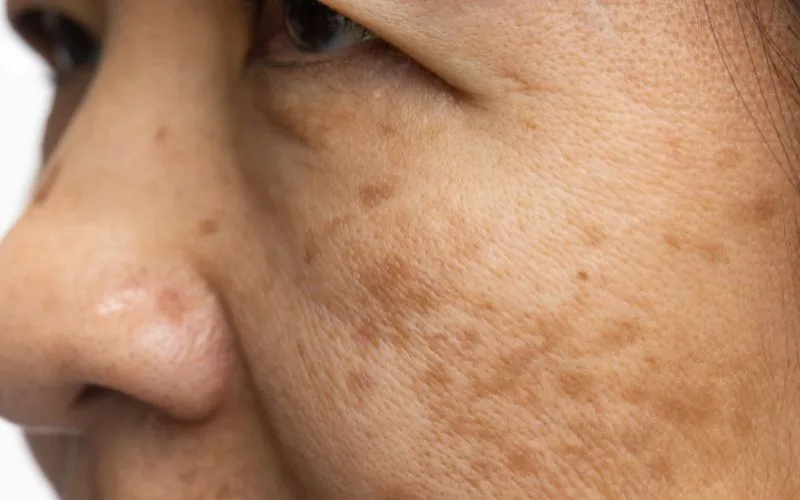 Understanding Pigmentation and its Causes