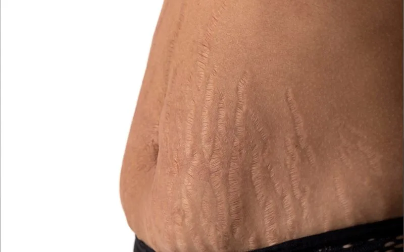 Understanding Stretch Marks