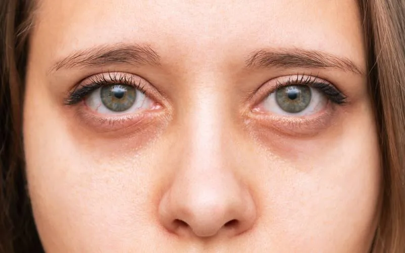 Understanding Tired Eyes and Its Causes