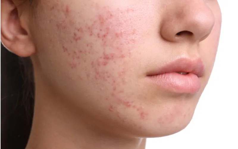 What Are Acne Scars and Pores