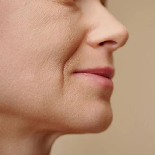 What Are Nasolabial Folds