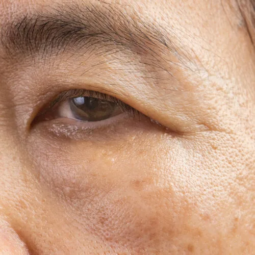 What Are The Key Symptoms of Droopy Eyelids