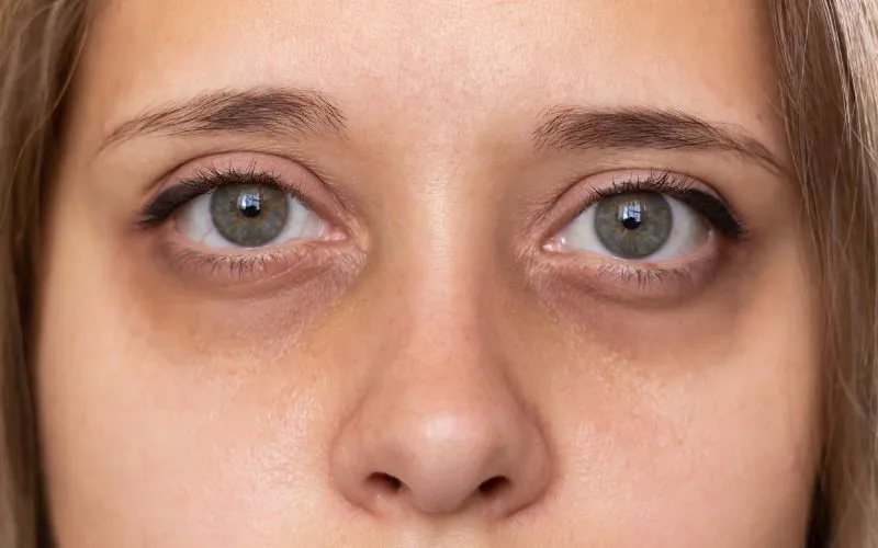 What Causes Eye Bags