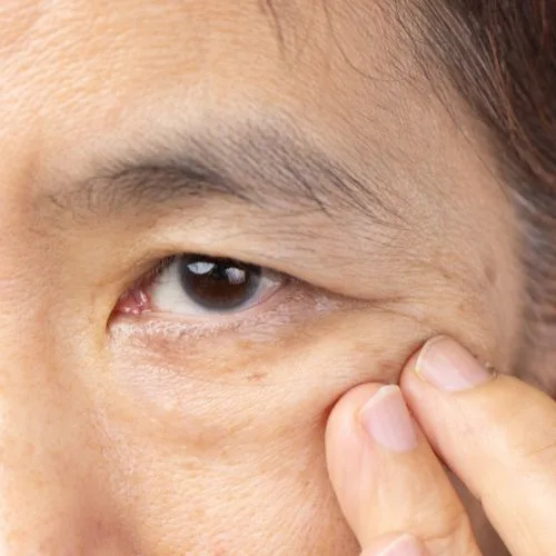 What Causes of Droopy Eyelid