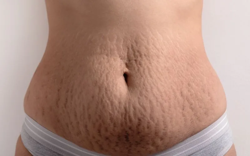 What are stretch marks & how to get rid of stretch marks