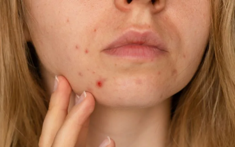 What are the causes of acne