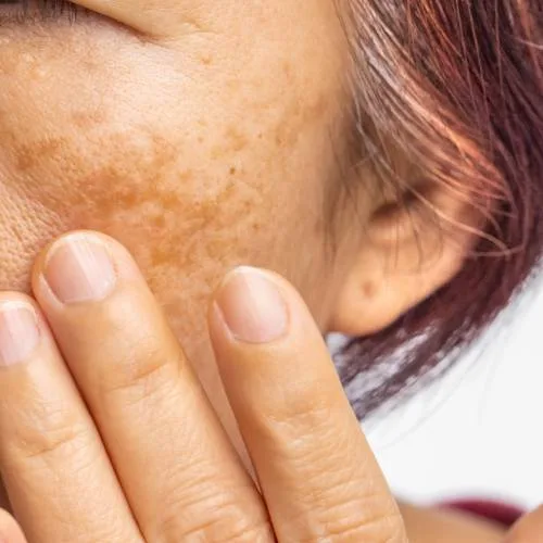 What causes Pigmentation and treatments