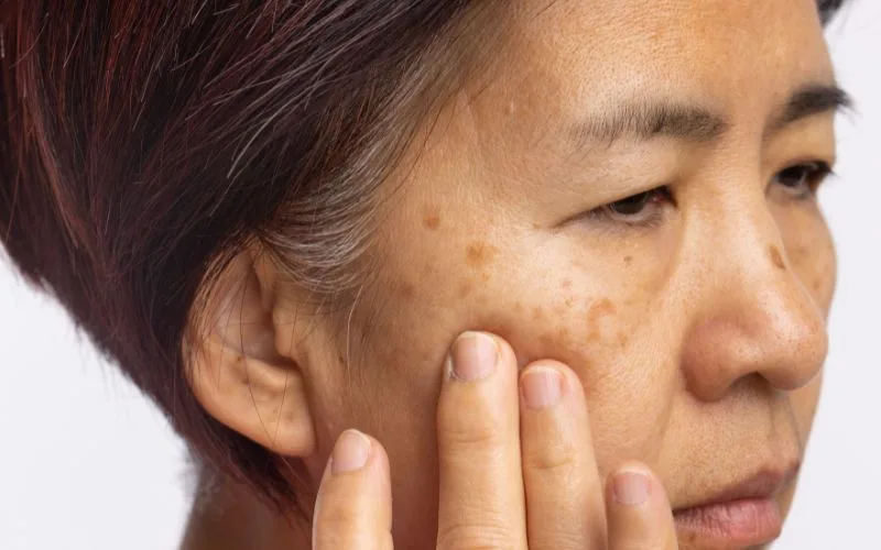 What causes pigmentation how to get rid of them
