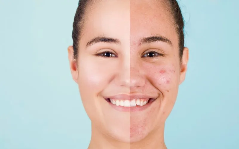 What is the Best Acne Scars And Pores Treatment