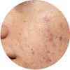 Morpheus8-treatment-for-Scarring-from-acne-surgery-or-trauma